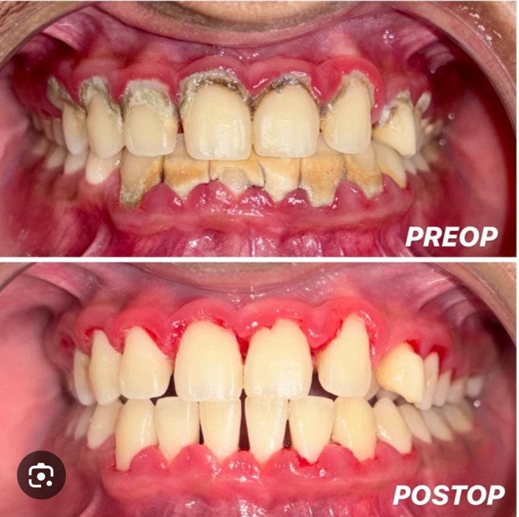 Before and after dental cleaning photos showing removal of heavy tartar from inflamed gums.