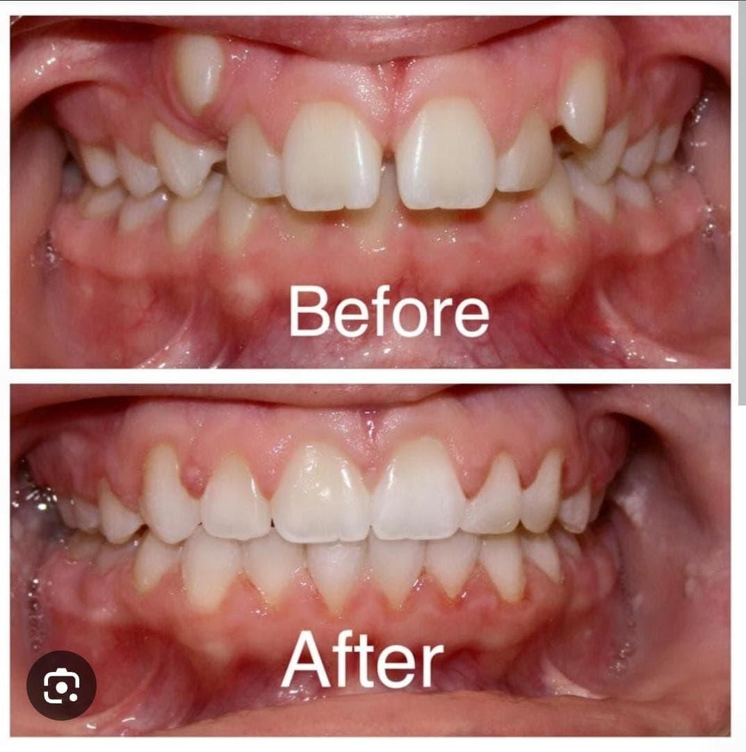 Before and after comparison showing crowded, misaligned teeth corrected into a straight, uniform smile.