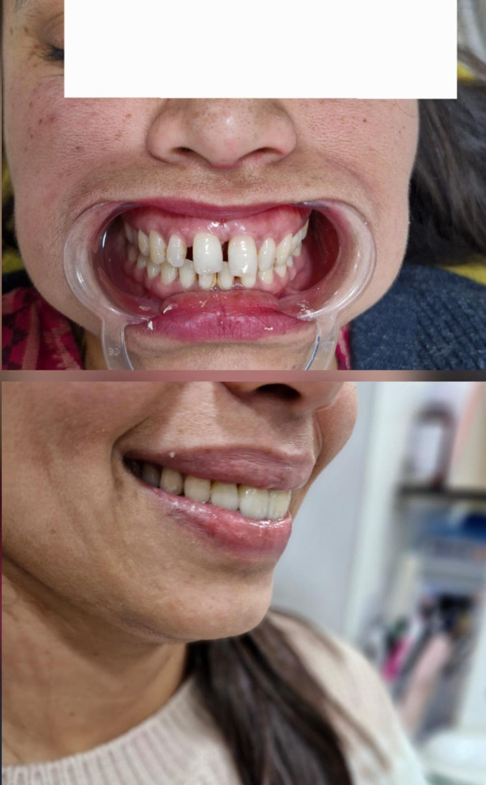 Before and after photos showing the closure of a gap between upper front teeth.