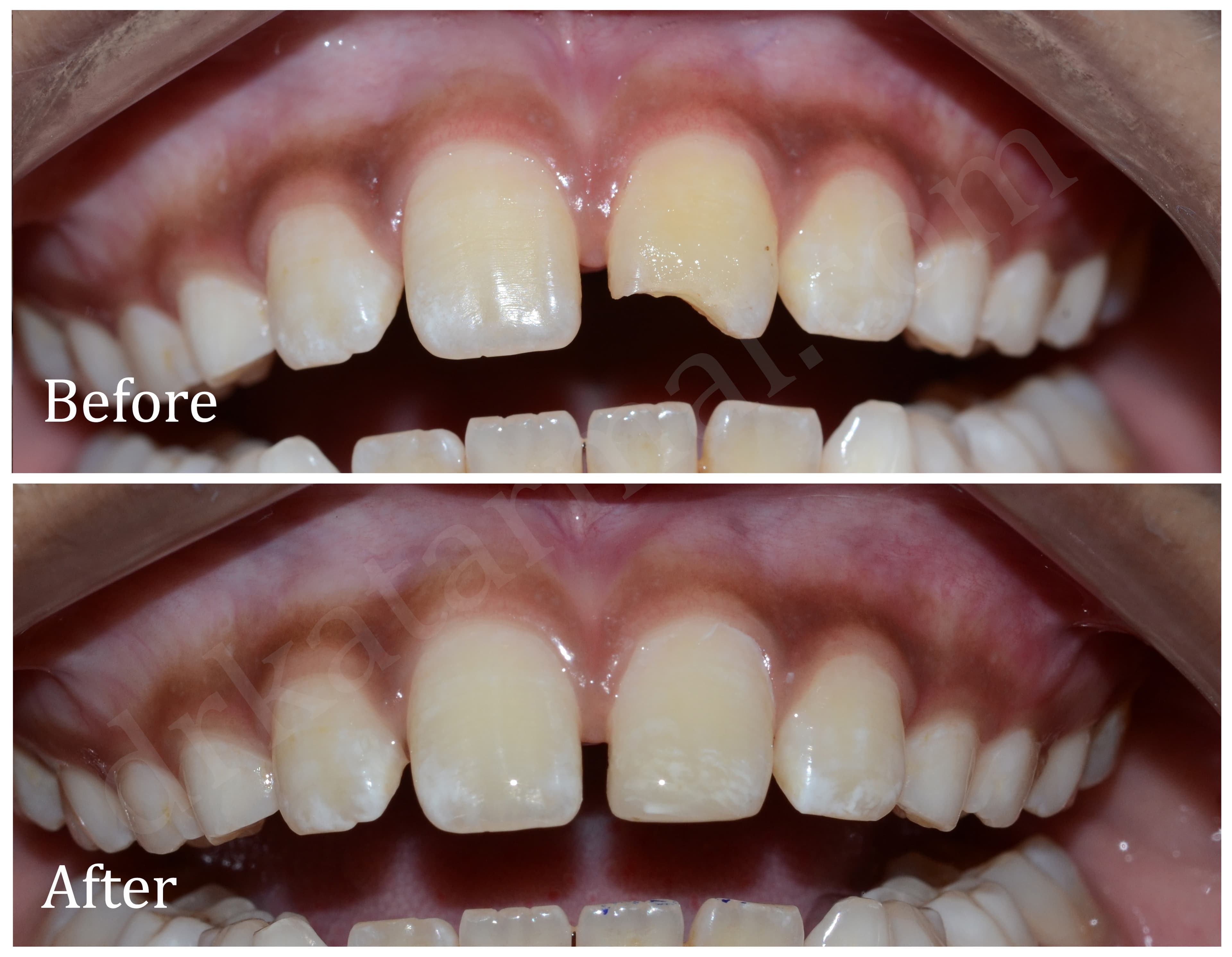 Before and after comparison showing the repair of a chipped upper front tooth.